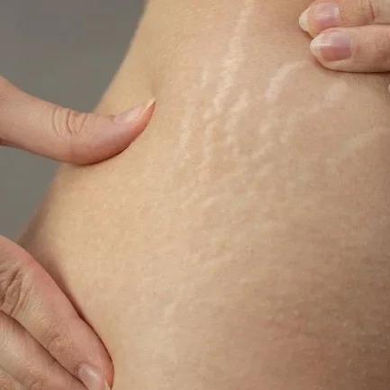 Manfaat Daun Pegagan Sembuhkan Stretch Mark Pada Kulit
