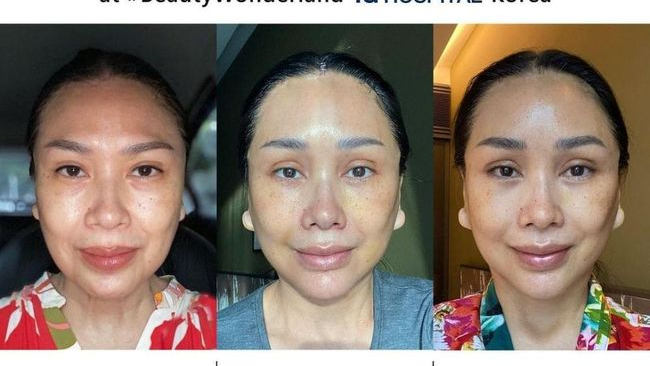 Titi DJ sebelum dan sesudah menjalani rhinoplasty, artis Indonesia rhinoplasty