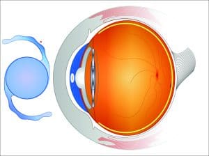 RLE (Refractive Lens Exchange)