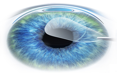 ReLEx SMILE (Refractive Lenticule Extraction, Small Incision Lenticule Extraction)